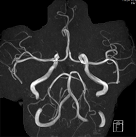 1.5テスラMRI