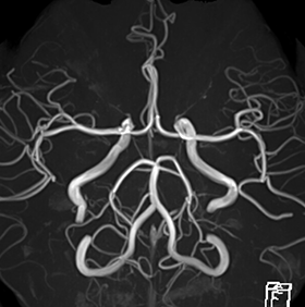 3テスラMRI