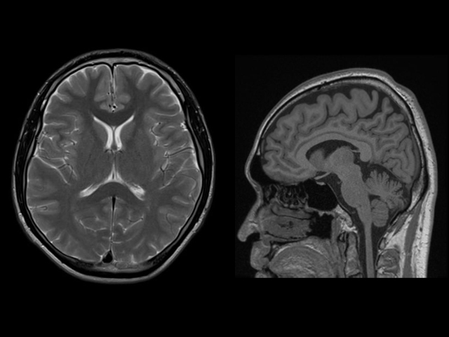 脳MRI