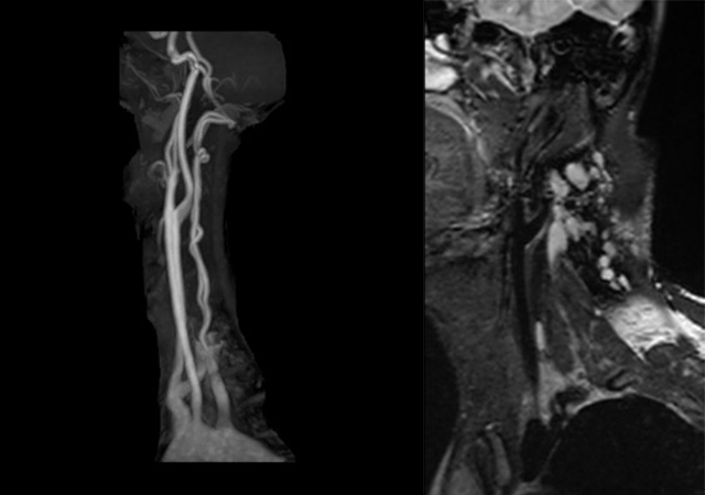 頸部MRIによるプラーク検査とMR angiography