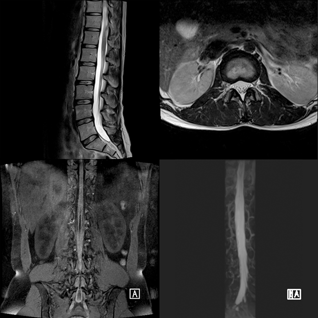 脊椎、関節MRI
