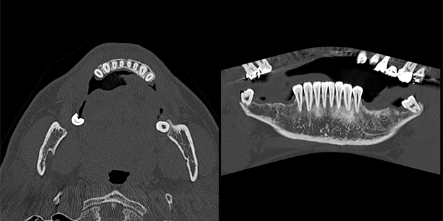 下顎CT 軸位断 下顎CT 冠状断
