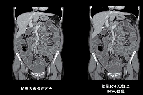 従来のCTの半分の放射線量で同等の画像が得られる被ばく低減アプリケーションソフト
